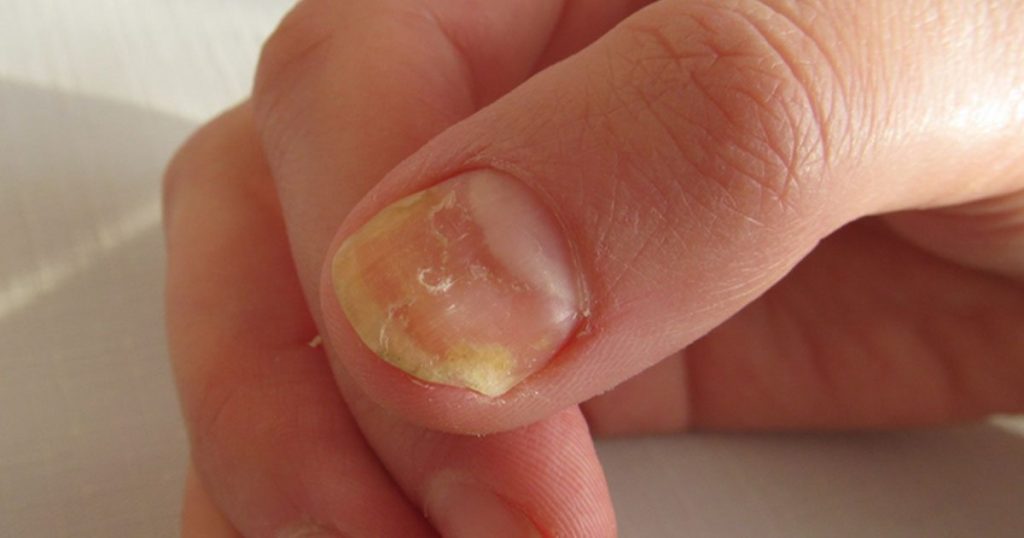 biter på skinnet runt naglarna